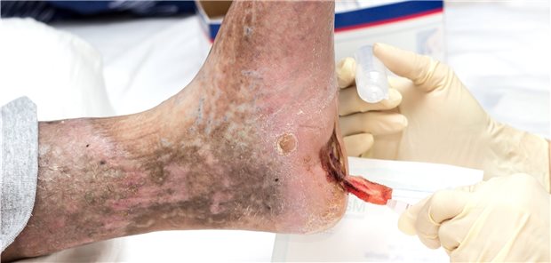 Welcher Verband ist jetzt der richtige? Patienten mit diabetischem Fußsyndrom bedürfen innovativer Wundmanagementlösungen.