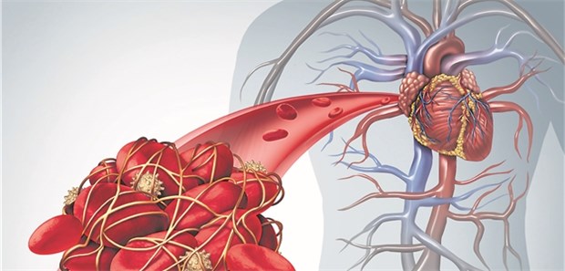 Welches ist die optimale Dauer der dualen Plättchenhemmung beim akuten Koronarsyndrom?