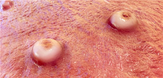 WHO: Lieferausfälle bei Diagnostika schränken Mpox-Monitoring ein Weltweit hat die Zahl der bestätigten Mpox-Fälle die Schwelle von 100.000 überschritten, so die WHO.