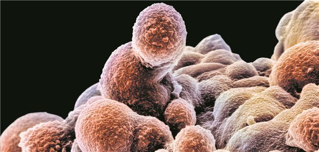 Wenn Prostatakrebszellen (angefärbtes Elektronenmikroskop-Bild) STAT3-positiv sind, sprechen sie wohl auf eine Behandlung mit Metformin an.