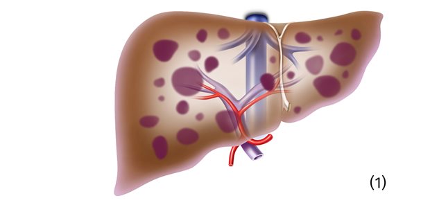 Wenn eine Leber von Metastasen befallen ist (Zeichnung) und ein Spenderorgan nicht zur Verfügung steht, kann die Zwei-Schritt-Lebendlebertransplanation eine Option sein. Das geht aus einer Studie hervor.
