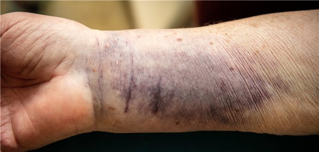 Wenn eine pflegebedürftige Patientin ungewöhnliche Verletzungen aufweist, sollte auch an Gewalt durch Kollegen gedacht werden, sagt der ZQP-Vorstandvorsitzender Suhr.