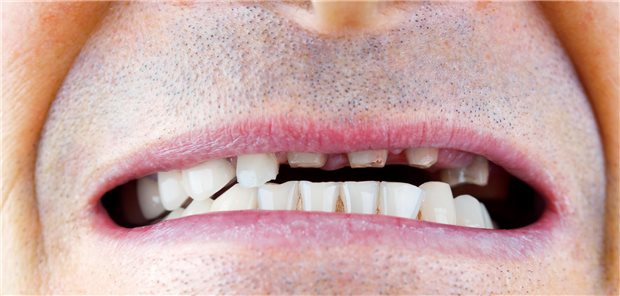 Mann mit  Lückengebiss 