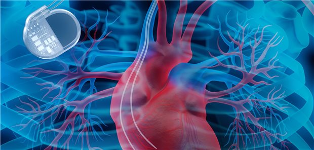 Gefährdet das iPhone 12 Patienten mit Schrittmachern? Kardiologen geben Entwarnung Wer einen Herzschrittmacher hat, sollte das iPhone 12 gemäß der Empfehlungen nicht direkt über dem implantierten Herzschrittmacher oder Defibrillator tragen oder benutzen.