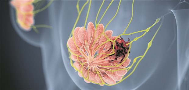 Wer profitiert von medikamentöser Brustkrebs-Prophylaxe?