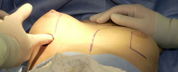 Knifflige Haftungsfrage bei PIP-Implantaten Wer trägt die Kosten für den Austausch fehlerhafter Implantate? Das Produkthaftungsgesetz bietet dafür neue Denkansätze.