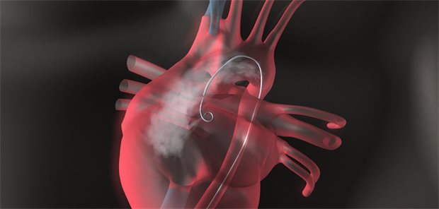Werden an den Herzkranzarterien Verengungen festgestellt, können sie durch die transarterielle Linksherz-Katheteruntersuchung aufgeweitet und mit einem Stent behandelt werden.