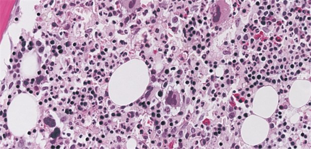 Zu viel Testosteron im Blut Wichtig bei Polyglobulie: ein Blick aufs Testosteron.
