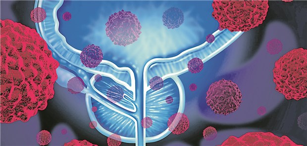 Möglicher Prognosemarker entdeckt Wichtiger Aspekt für die Therapieentscheidung beim Prostatakrebs: Wird sich der Tumor aggressiv oder weniger aggressiv verhalten?
