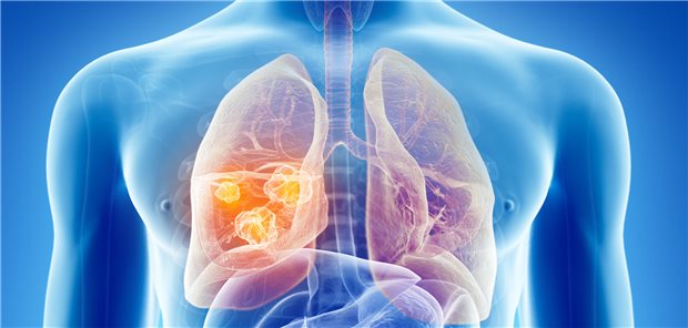 Wie Krebsforschende um Dr. Tina Cascone vom Anderson Cancer Center in Houston berichten, betrug die mediane Nachbeobachtungsdauer 25,4 Monate. Nach 18 Monaten lebten noch 70,2 Prozent in der Gruppe mit Nivolumab, aber nur 50,0 Prozent ohne perioperativen ICI ereignisfrei, was einer Risikoreduktion um 42 Prozent mit dem ICI entspricht.