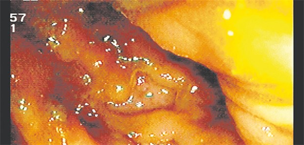 Wie ausgestanzt sehen diese Crohn-Ulzera aus. Die Therapie soll sie mitsamt aller anderen Entzündungszeichen zum Verschwinden bringen.