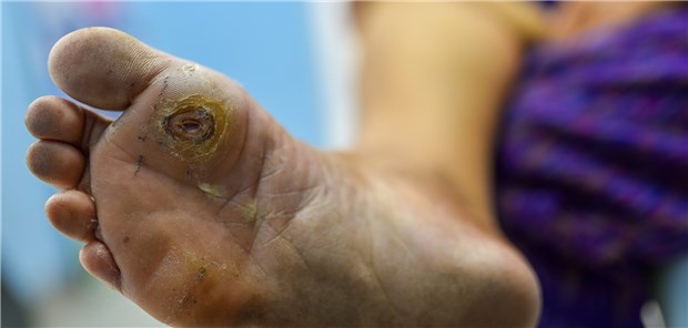 Wie behandeln? Anhand von Handyfotos sollen sich Hausärzte künftig mit Experten zum diabetischen Fußsyndrom beraten können.