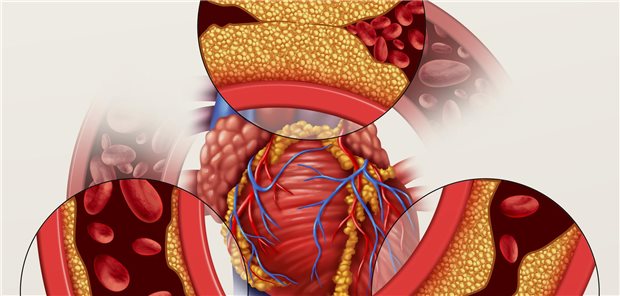 Schematische Darstellung von verkalkten Herzkranzgefäßen