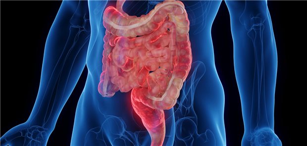 Dreidimensionale gerenderte medizinische Illustration des Darms eines Mannes mit Morbus Crohn.