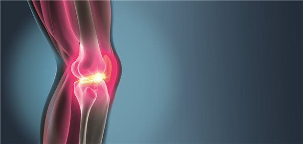 Wie hoch ist das Risiko, dass eine Kniearthrose fortschreitet? Mit 15 Serum-Peptiden lässt sich, einer Studie zufolge, vorhersagen, wer ein besonders hohes Progressionsrisiko hat.