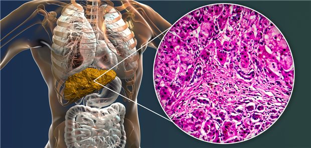 Wie kann kann das Fortschreiten einer  primär biliären Cholangitis am besten hinausgezögert werden?