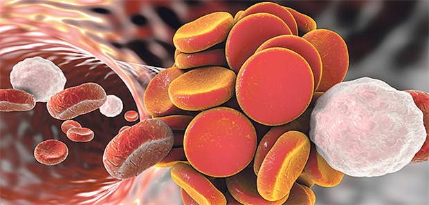 Wie lassen sich Störungen im Blutfluss verhindern? Bei Infarktpatienten ein Dauerthema.