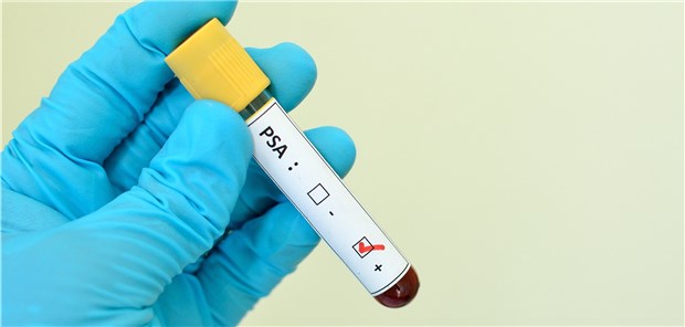 Wie sinnvoll ist der PSA-Test? Das ist umstritten.