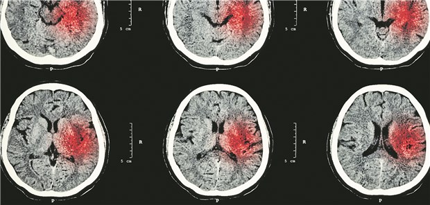 Wie stark sollte der systolische Druck bei intrazerebraler Blutung gesenkt werden?