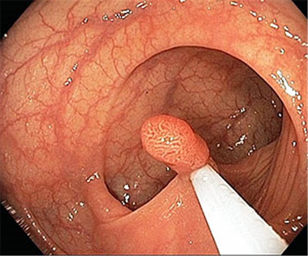 Screening auf Darmkrebs lohnt sich Wird bei der Koloskopie ein Polyp entdeckt, könnte eine Zweitspiegelung früher indiziert sein als bei Polypenfreiheit.