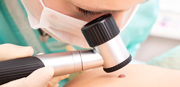 Neuer Test für frühe Prognose Wird durch Hautkrebsscreening tatsächlich ein malignes Melanom diagnostiziert, muss geklärt werden, ob Tumorzellen bereits in Wächterlymphknoten gestreut haben. Mit einer neuen Methode ist das sehr genau möglich.