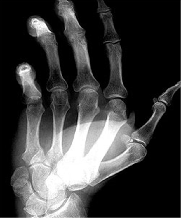 Off-Label-Use an der Tagesordnung Wird jeder zweite Rheuma-Patient off-label behandelt?