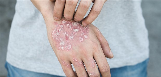 Scham vor sich selbst ist größte Belastung Wissenschaftler sind dem Stigmatisierungserleben von Patienten mit Psoriasis nachgegangen.
