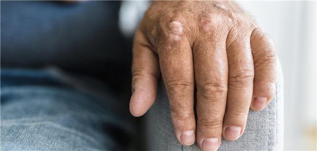 Wo überall außer an der Hand manifestiert sich die Psoriasis?