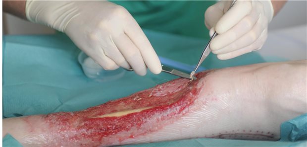 Wundbehandlung: Auch die Vakuumversiegelung ist nun ab Oktober im EBM abgebildet.