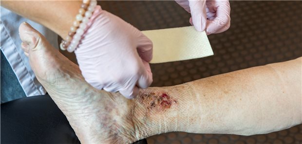 Wundbehandlung verlangtnach der richtigen Strategiedes behandelnden Arztes.