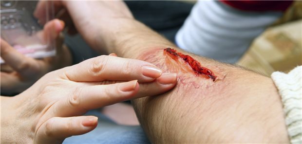 Wunden stellen für Personen mit Hämophilie A eine besondere Gefahr dar: Eine Gentherapie soll Blutungen reduzieren.