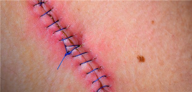 Nicht-Betalaktam-Antibiotika erhöhen wohl das Risiko für postoperative Wundinfektionen Eine genähte Wunde