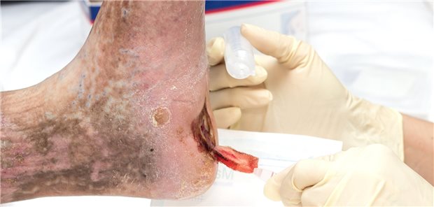 Wundversorgung bei einem diabetischen Fußsyndrom.