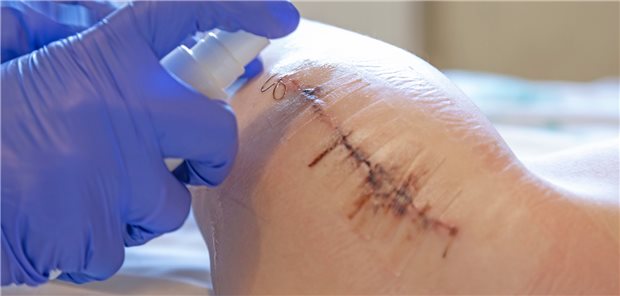 Wundversorgung nach Hüftgelenkoperation: Nach solchen Eingriffen wird eine besonders lange VTE-Prophylaxe empfohlen.