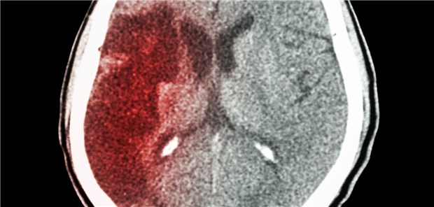 Wurde bei Hypertonikern mit Schlaganfall der Blutdruck rasch gesenkt, reduzierte sich die Reinfarktrate um 56 Prozent.