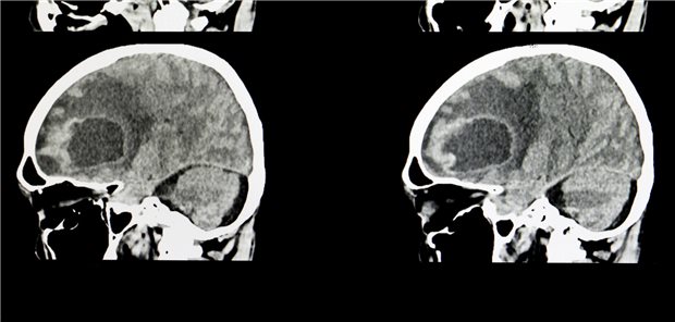 CT-Scan des Gehirns eines Patienten mit einem großen metastasierten Tumor.