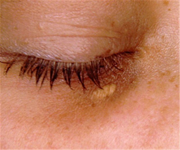Kleine Knötchen, hohes Herzrisiko Xanthelasma am Unterlid: Hinweis auf ein möglicherweise erhöhtes Herzrisiko.