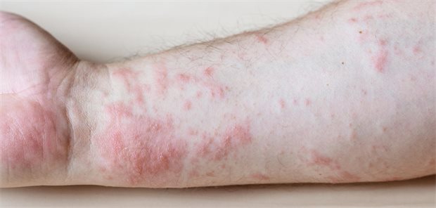 Eine Dermatitis an einem Unterarm.