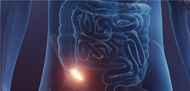 Eine Illustration mit einer glühenden entzündeten Appendix.