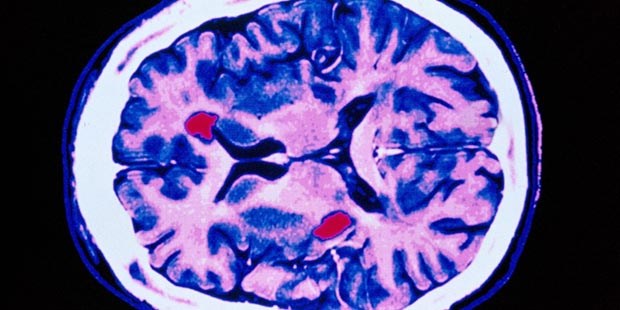 Hersteller sieht Versorgung gesichert Zeichen der Multiplen Sklerose: Für die Therapie mit Alemtuzumab will der Hersteller jetzt klinische Studien durchführen.
