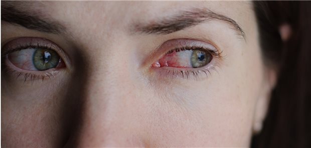 Corona-Ansteckung wohl nicht übers Auge Zeichen einer Konjunktivitis hatten nur drei Prozent von 2000 COVID-19-Patienten. Dies spricht Experten zufolge gegen einen relevanten Infektionsweg über die Bindehäute.