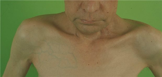 Zeichen von Mangelernährung: Für das Management Betroffener mit COVID-19 gibt es jetzt einen Leitfaden.