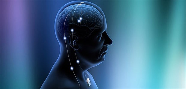 Zielstrukturen der tiefen Hirnstimulation sind epileptogene Foci, gegebenenfalls auch nicht läsionale epileptogene Zonen.
