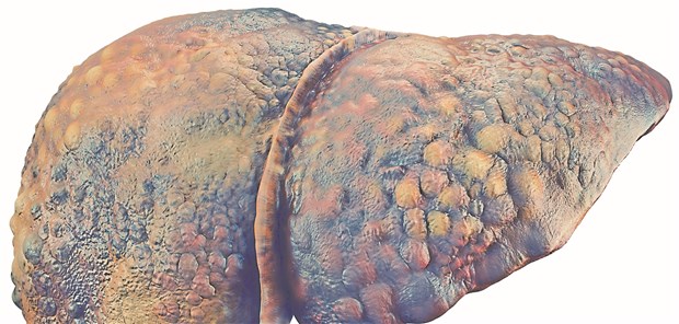 Zirrhose: In den großen Studien zu NOAK waren fortgeschrittene Lebererkrankungen durchweg ein Ausschlusskriterium.