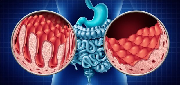 Was bei gestörter L-Thyroxin-Resorption zu klären ist Zöliakie mit typischer Abflachung der Dünndarmschleimhaut. Bei Betroffenen ist die Resorption von zum Beispiel L-Thyroxin deutlich eingeschränkt.