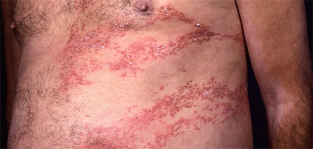 Zoster erzeugt wohl eine prothrombotische Umgebung und begünstigt so die Ruptur atherosklerotischer Plaques.