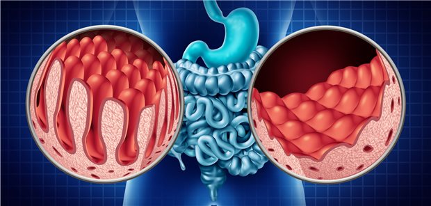 Zottenatrophie (rechts) ist ein typisches Merkmal für eine Zöliakie.