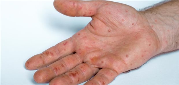Auf der Hand eines Mannes ist deutlich der Ausschlag durch eine Mpox-Infektion zu sehen.