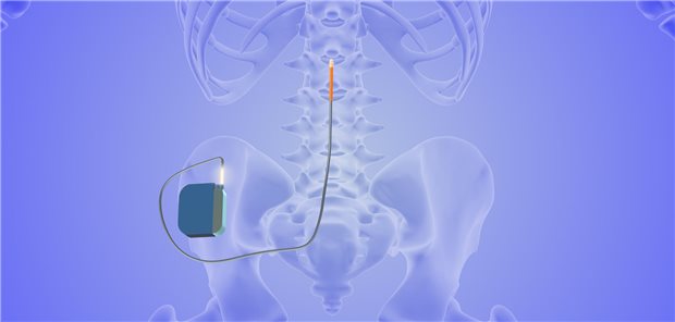 Die epidurale Rückenmarkstimulation ist ein neuromodulatorisches, reversibles interventionelles Verfahren für Erkrankte mit chronischen Schmerzen.