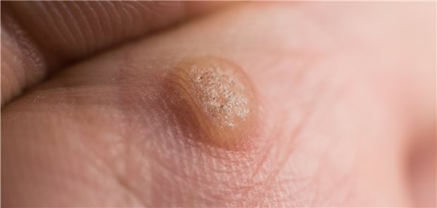 Zu den Therapieoptionen bei Warzen gehört auch der Laser. Muss er mit einer Lokalanästhesie kombiniert werden?